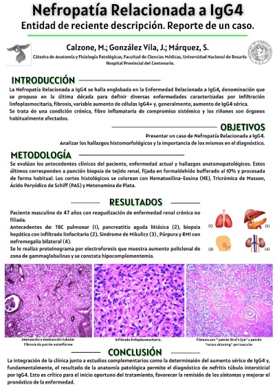Read more about the article NEFROPATÍA RELACIONADA A IgG4: ENTIDAD DE RECIENTE DESCRIPCIÓN. REPORTE DE UN CASO