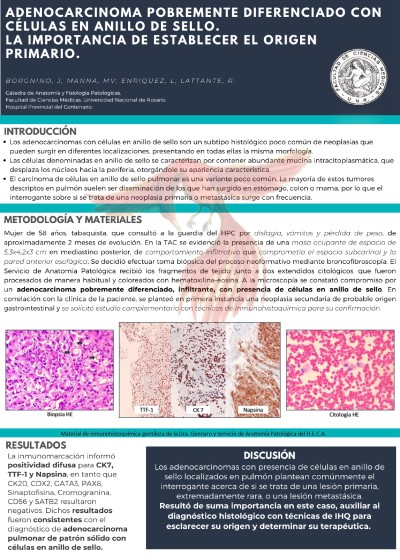 Read more about the article ADENOCARCINOMA POBREMENTE DIFERENCIADO CON CÉLULAS EN ANILLO DE SELLO. LA IMPORTANCIA DE ESTABLECER EL ORIGEN PRIMARIO.
