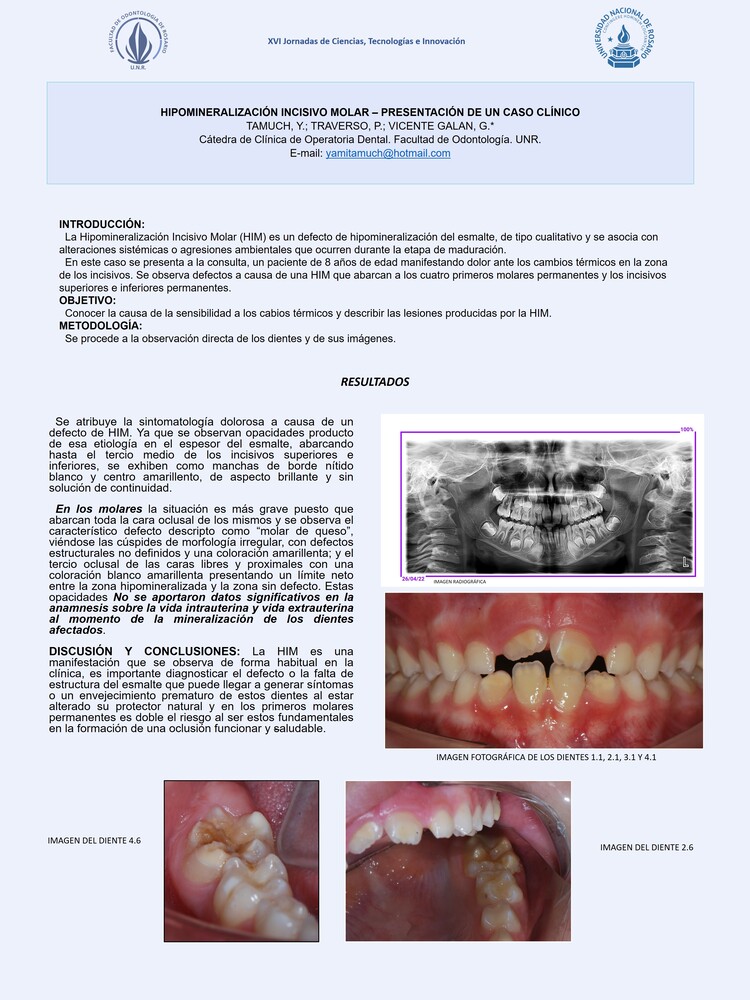 Read more about the article Hipomineralización Incisivo Molar – Presentación de un Caso Clínico
