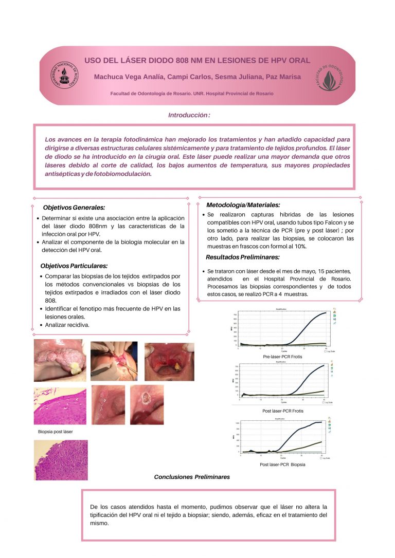 Read more about the article USO DEL LÁSER DIODO 808 NM EN LESIONES DE HPV ORAL