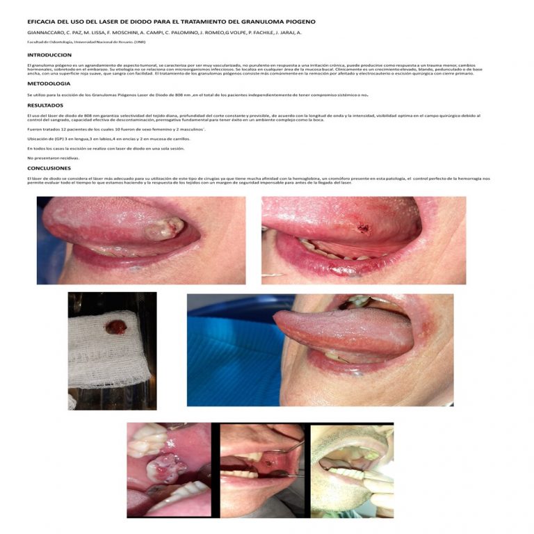 Read more about the article Eficacia del Uso del Laser de Diodo en el Tratamiento del Granuloma Piógeno