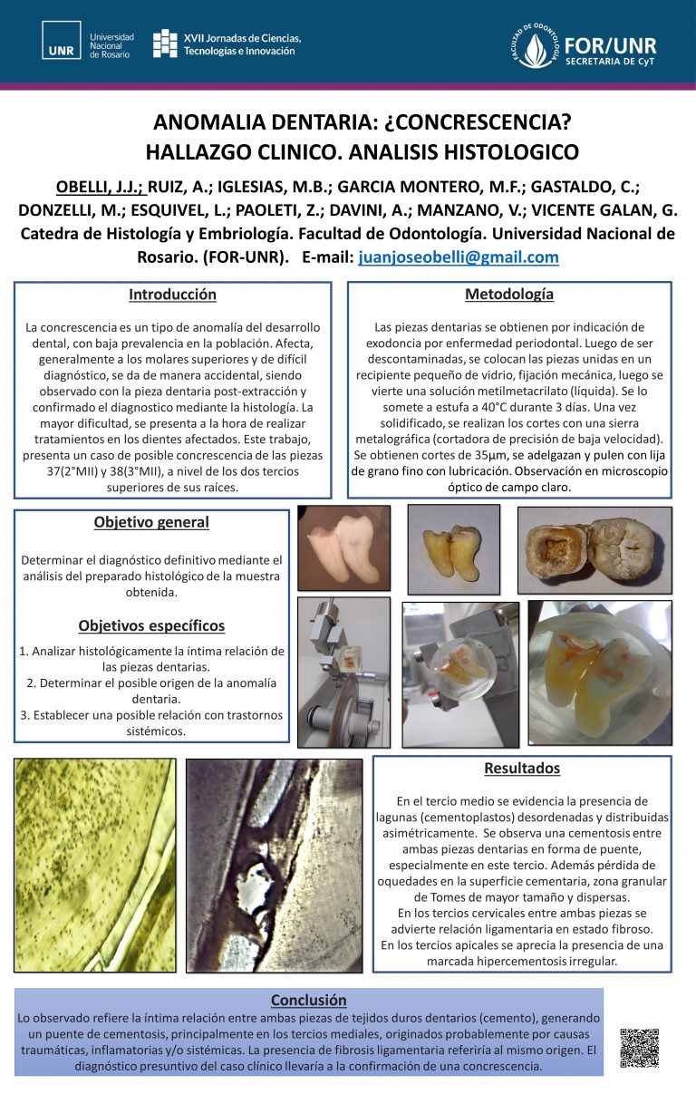 Read more about the article ANOMALIA DENTARIA: ¿CONCRESCENCIA? HALLAZGO CLINICO. ANALISIS HISTOLOGICO.