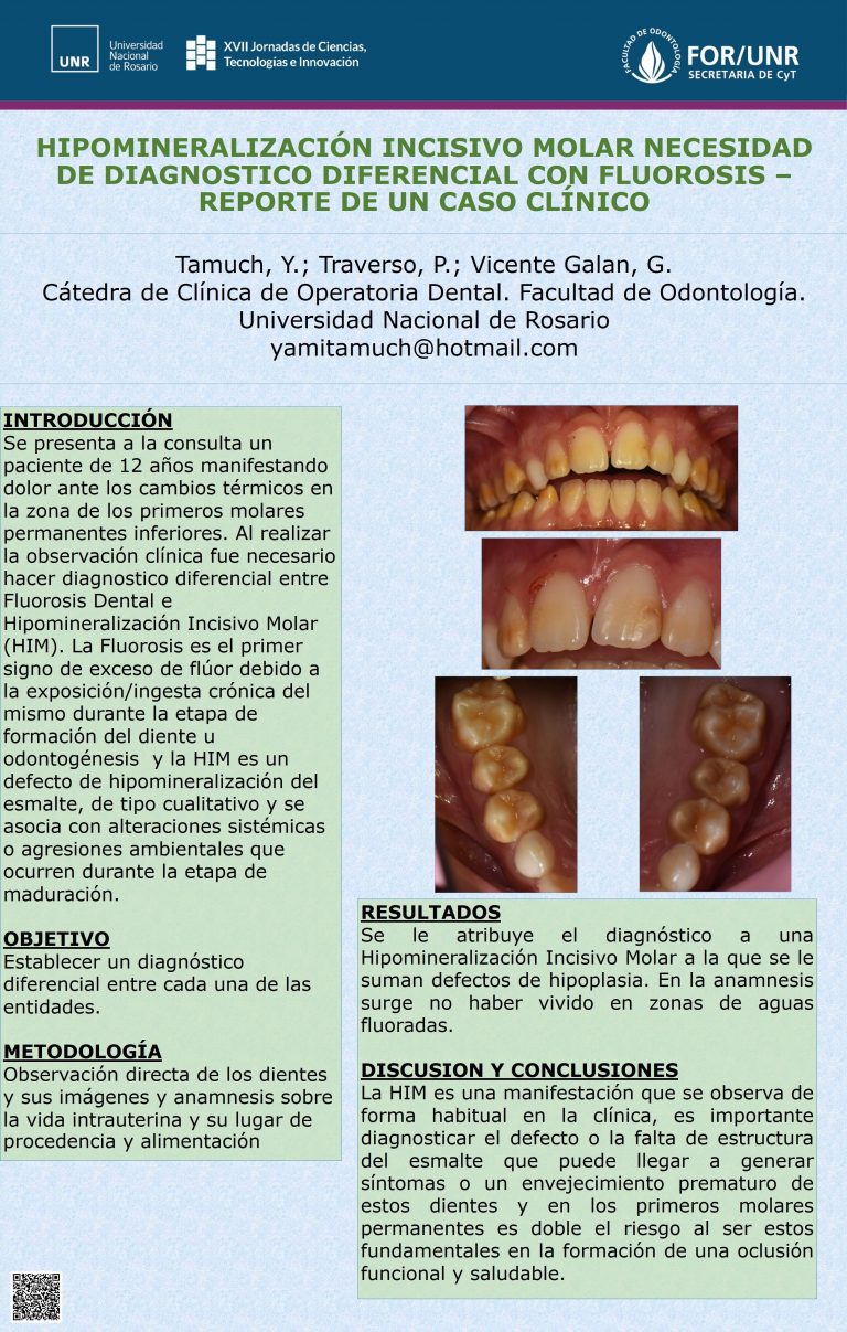 Read more about the article HIPOMINERALIZACIÓN INCISIVO MOLAR NECESIDAD DE DIAGNOSTICO DIFERENCIAL CON FLUOROSIS – REPORTE DE UN CASO CLÍNICO