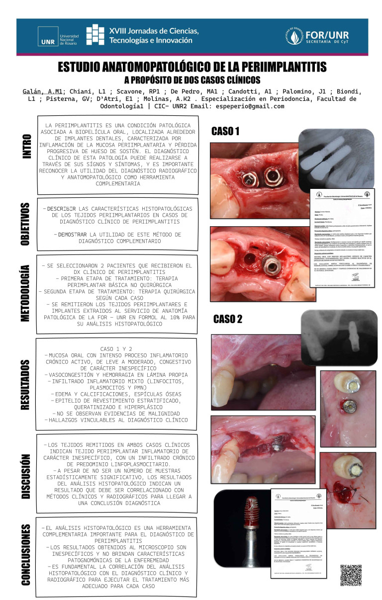 Read more about the article ESTUDIO ANATOMOPATOLÓGICO DE LA PERIIMPLANTITIS. A PROPÓSITO DE UN CASO CLÍNICO